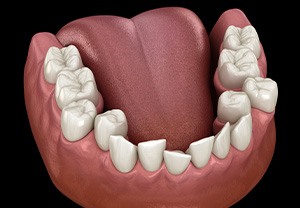 Illustration of crooked teeth