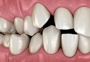 Illustration of gapped teeth